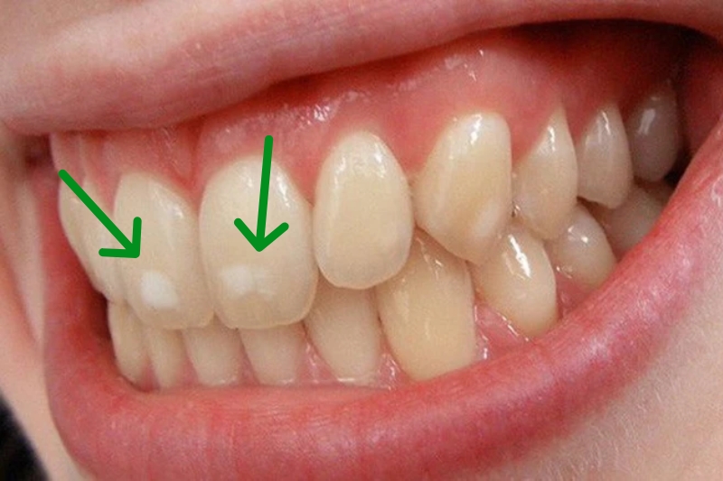 Đốm trắng trên răng xuất hiện do nhiễm florua